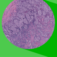 Curso online: Diagnóstico molecular del carcinoma de mama - 2ª edición