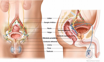 Cancer de prostata fases, Cancer de prostata fases